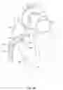 Fig. 17 - Delivery devices and wall apposition sensing