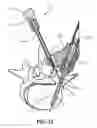 Fig. 20 - Bone fixation screw with deployable anchors