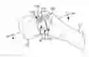 Fig. 01 - Total hip replacement surgical guide tool