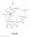 Fig. 06 - Total hip replacement surgical guide tool