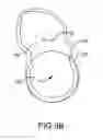 Fig. 20 - Total hip replacement surgical guide tool