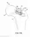 Fig. 26 - Total hip replacement surgical guide tool