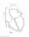 Fig. 02 - METHOD AND APPARATUS FOR RECAPTURING AN IMPLANT FROM THE LEFT ATRIAL APPENDAGE