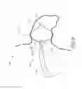 Fig. 07 - METHOD AND APPARATUS FOR RECAPTURING AN IMPLANT FROM THE LEFT ATRIAL APPENDAGE