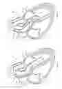 Fig. 02 - Device and methods for self-centering a guide catheter