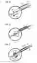 Fig. 13 - Infusion of drugs