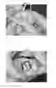 Fig. 04 - Meniscus for joint reconstruction