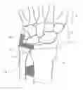 Fig. 01 - Distal radioulnar joint prosthesis and method of use