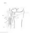 Fig. 03 - Distal radioulnar joint prosthesis and method of use