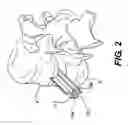 Fig. 03 - Vertebral implants and related methods of use