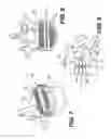 Fig. 06 - Vertebral implants and related methods of use