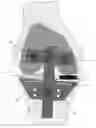 Fig. 01 - Arthroplasty apparatus and method