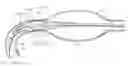 Fig. 01 - Balloon assisted endoluminal prosthesis deployment