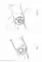 Fig. 11 - Balloon assisted endoluminal prosthesis deployment