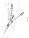 Fig. 14 - Balloon assisted endoluminal prosthesis deployment