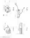 Fig. 18 - Balloon assisted endoluminal prosthesis deployment