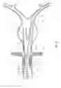 Fig. 20 - Balloon assisted endoluminal prosthesis deployment