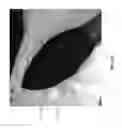 Fig. 25 - Negative pressure wound closure device