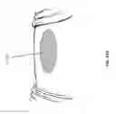 Fig. 30 - Negative pressure wound closure device