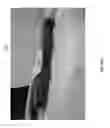 Fig. 40 - Negative pressure wound closure device
