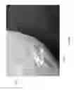 Fig. 46 - Negative pressure wound closure device