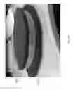Fig. 56 - Negative pressure wound closure device