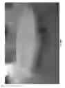 Fig. 74 - Negative pressure wound closure device