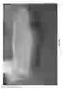 Fig. 75 - Negative pressure wound closure device