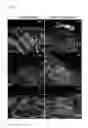Fig. 08 - Laser-assisted intradermal administration of active substances