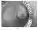 Fig. 06 - Lyophilized moldable implants containing an oxysterol