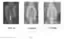 Fig. 08 - Lyophilized moldable implants containing an oxysterol