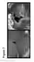 Fig. 08 - DEVICES AND METHODS FOR INHIBITING STENOSIS, OBSTRUCTION, OR CALCIFICATION OF A NATIVE HEART VALVE, STENTED HEART VALVE OR BIOPROSTHESIS