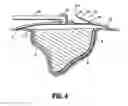 Fig. 05 - System for providing continual drainage in negative pressure wound therapy