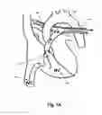 Fig. 02 - Pulmonary embolism apparatus