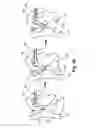 Fig. 03 - Pulmonary embolism apparatus