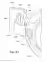 Fig. 47 - Positioning and stabilising structure and patient interface