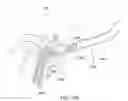 Fig. 94 - Positioning and stabilising structure and patient interface