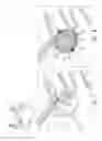 Fig. 05 - Double balloon catheter having a lobed inner balloon