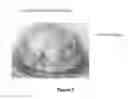 Fig. 04 - Methods for Treating Corneal and Conjunctival Inflammation and Inflammatory Disorders