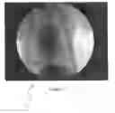 Fig. 02 - Registration of fluoroscopic images of the chest and corresponding 3D image data based on the ribs and spine