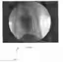 Fig. 04 - Registration of fluoroscopic images of the chest and corresponding 3D image data based on the ribs and spine