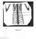 Fig. 06 - Registration of fluoroscopic images of the chest and corresponding 3D image data based on the ribs and spine