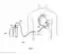 Fig. 06 - Auxiliary artificial heart system