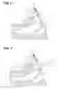 Fig. 06 - Marking method and resecting method