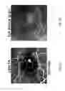 Fig. 18 - Method and device for the non-invasive indirect identification of sites of alterations of the blood-retinal barrier