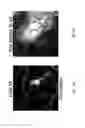 Fig. 23 - Method and device for the non-invasive indirect identification of sites of alterations of the blood-retinal barrier
