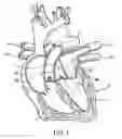 Fig. 02 - System and Method for Assisted Partitioning of Body Conduits