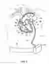 Fig. 03 - System and Method for Assisted Partitioning of Body Conduits