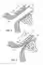 Fig. 05 - System and Method for Assisted Partitioning of Body Conduits