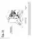 Fig. 15 - Robotic knee testing (RKT) device having decoupled drive capability and systems and methods providing the same